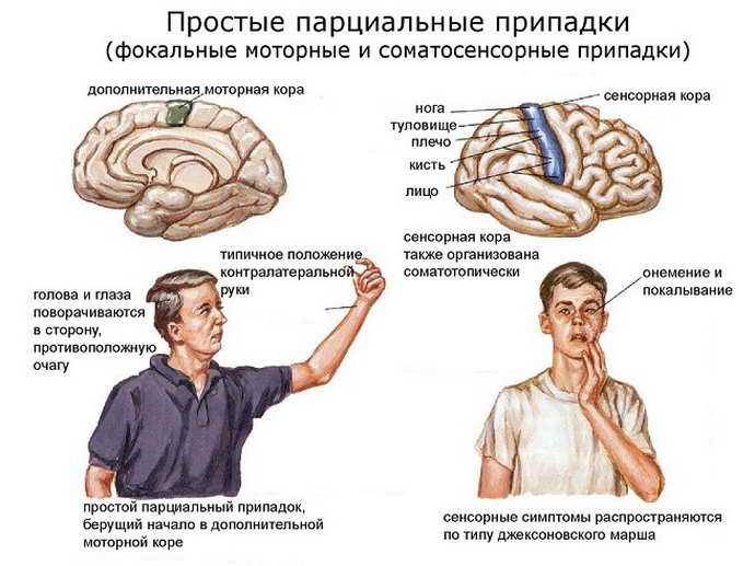 Височная эпилепсия