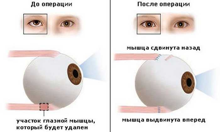 Как видят косоглазые люди: мир глазами человека с патологией