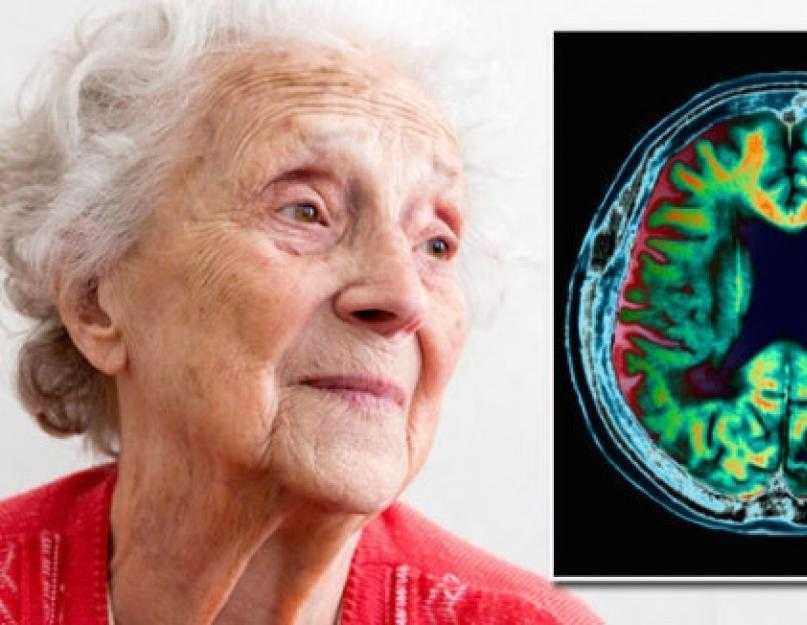 Возникновение сосудистой деменции и её терапия у пожилых людей