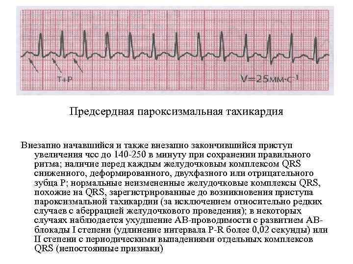 Тахикардия (сердцебиение) при неврозе и всд: симптомы, причины, лечение