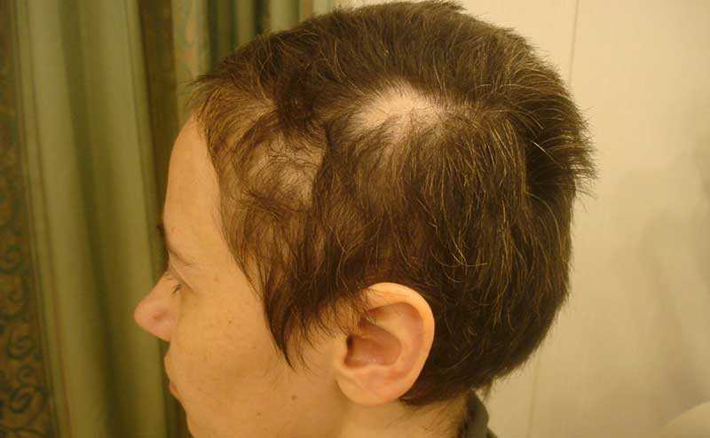 Трихотилломания – расстройство вырывания волос | психосома