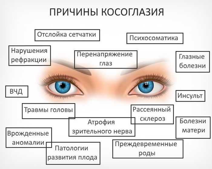 Что такое косоглазие: психосоматика зрения — глаза эксперт