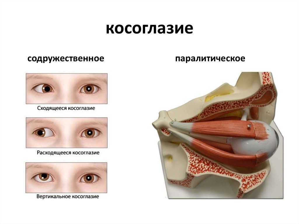 Косоглазие: причины, диагностика и лечение - статьи о глазных болезнях