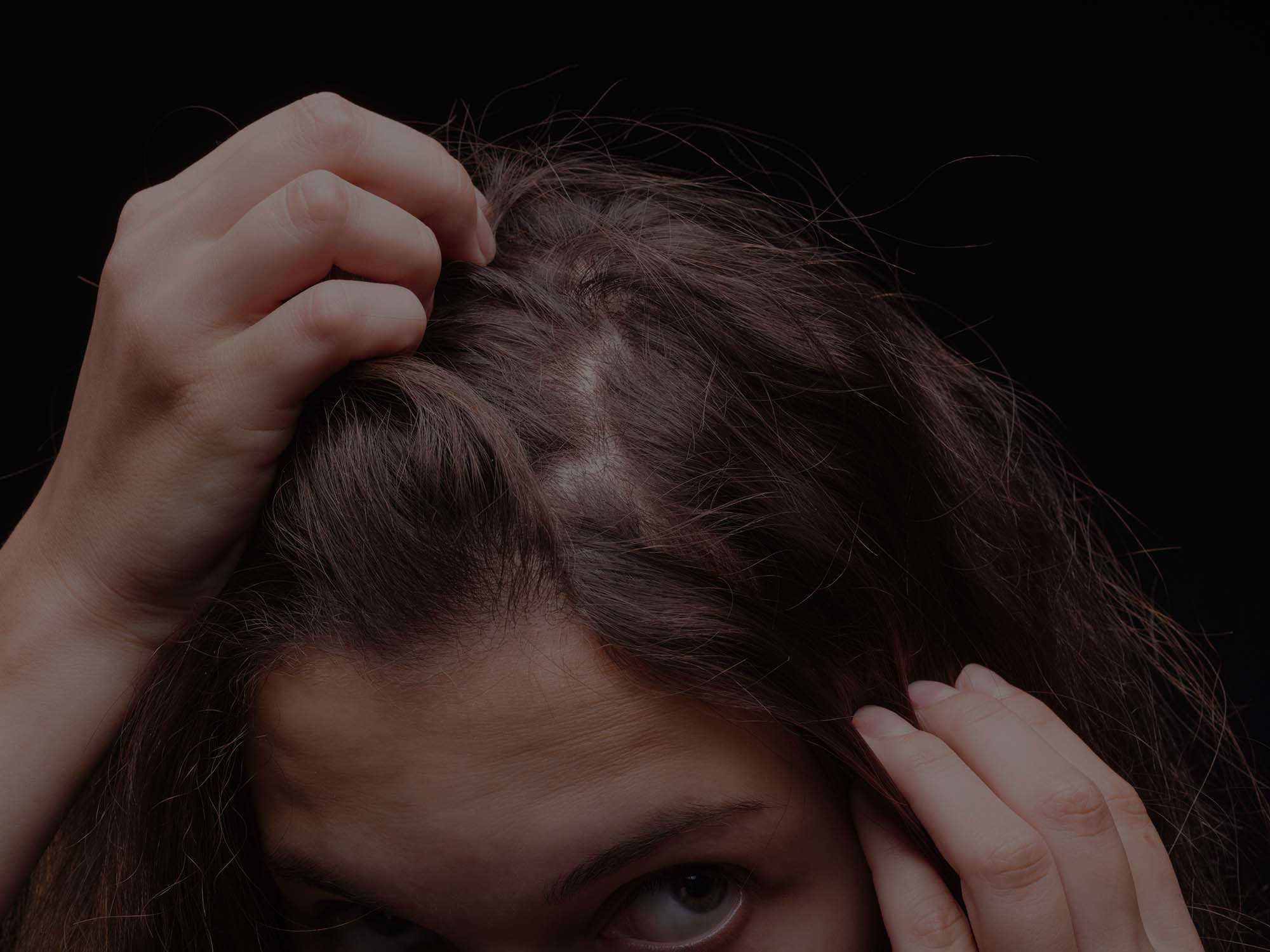 Трихотилломания – расстройство вырывания волос