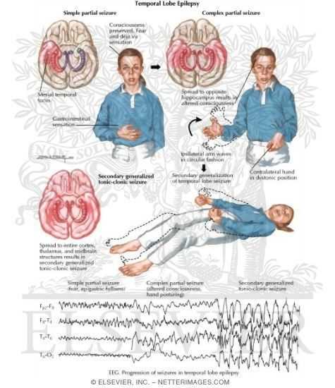 Височная эпилепсия – понятие о заболевании, основная информация о течении и терапии патологии